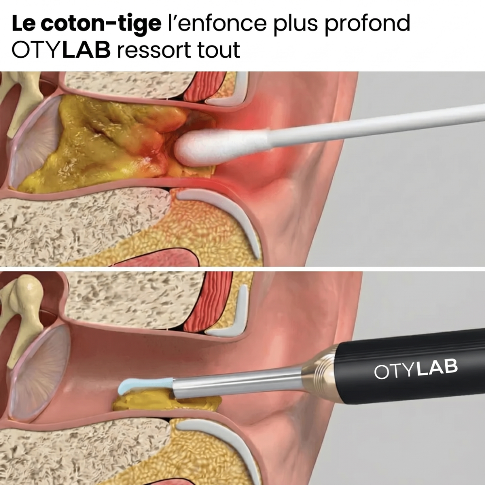 OTYLAB™ Pro — Nettoyeur d'Oreille Visuel à Caméra HD